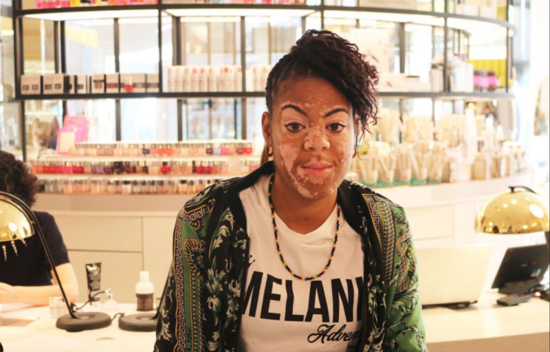 Rochelle trpí chorobou s názvem vitiligo.