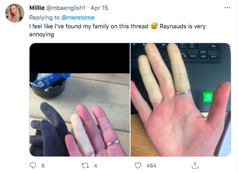 Bílé prsty kvůli vzácné nemoci 3