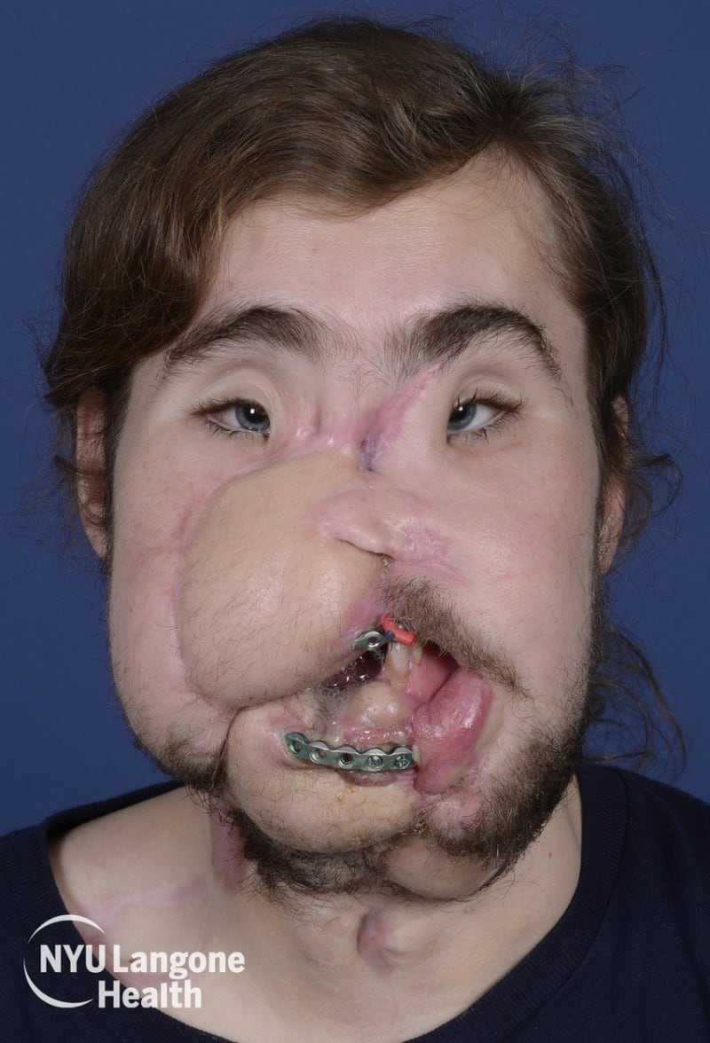 Cameron Underwood po transplantaci obličeje. 1