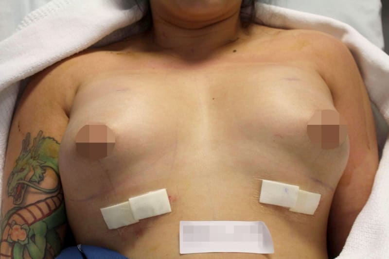 Plastická operace prsou se nepovedla 4