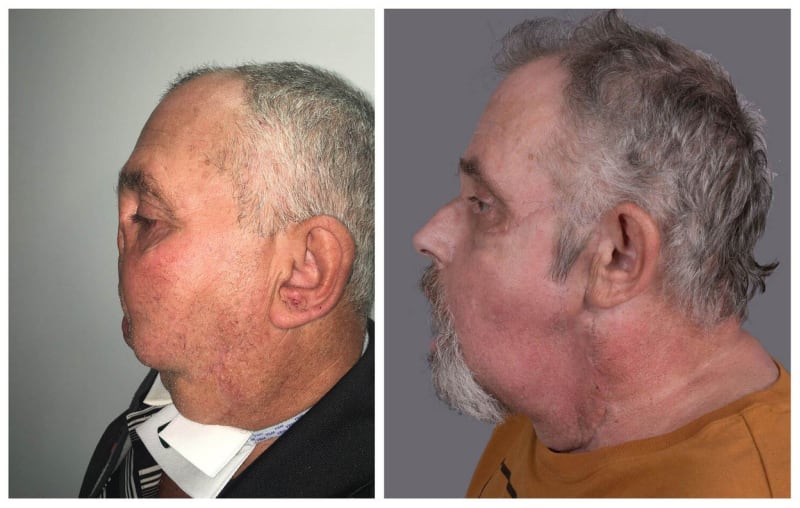 Nejstarší muž s transplantací obličeje 7