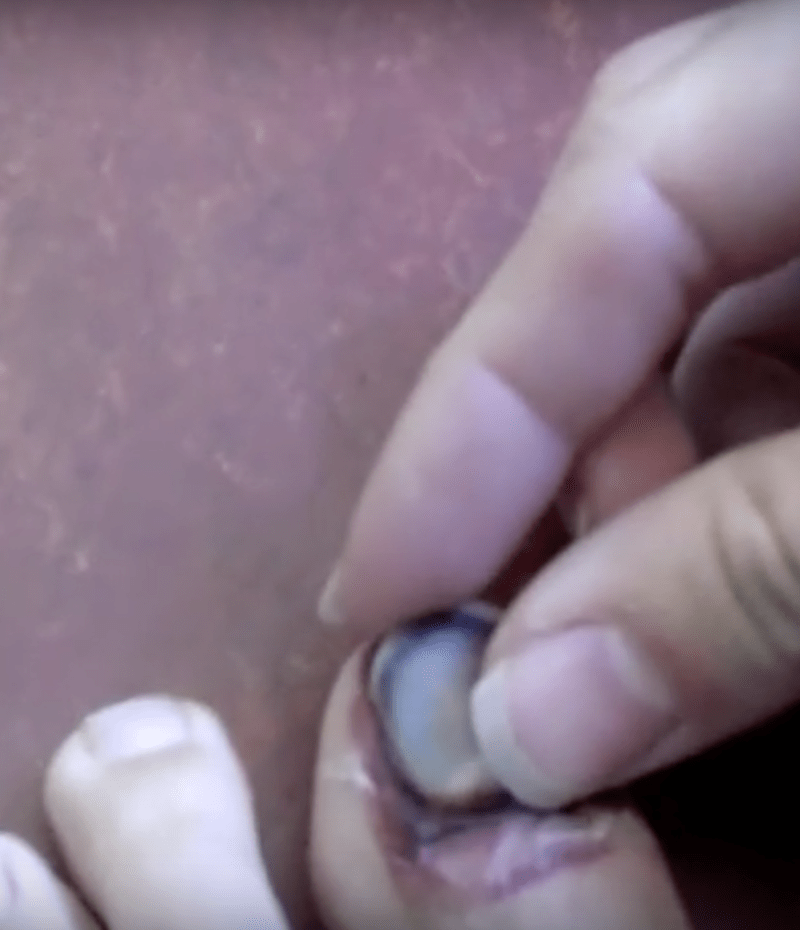 Nechutné video ukazuje, jak si týpek strhává nehet na palci u nohy.
