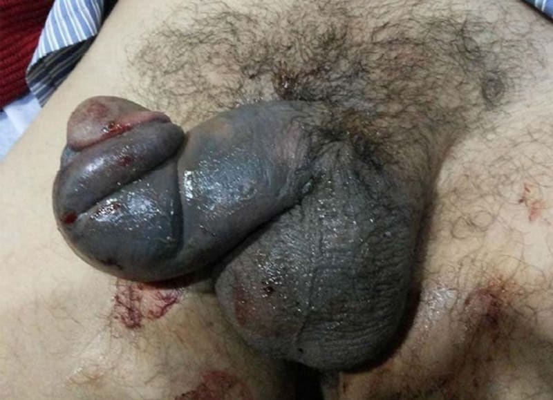 Takhle vypadá zlomený penis.