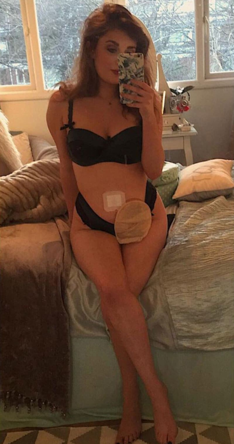 Žena zveřejnila fotky s vývodem střeva z břicha 6