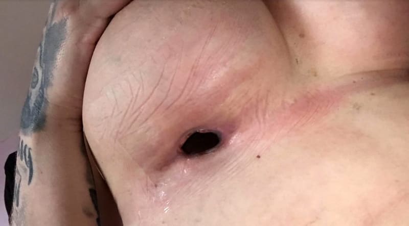 Žena má po zpackané operaci každé prso jinak velké 6