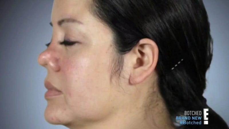 Žena se po liposukci probudila i s plastikou nosu 3