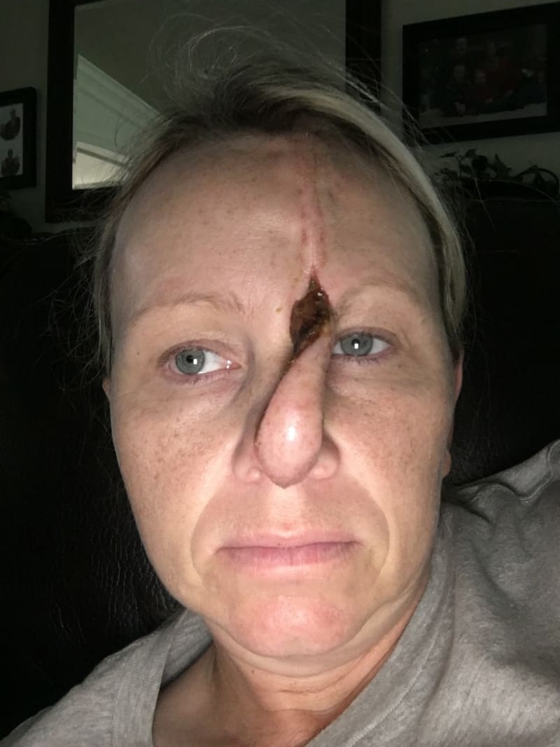 Žena s dírou v nose po rakovině kůže 3