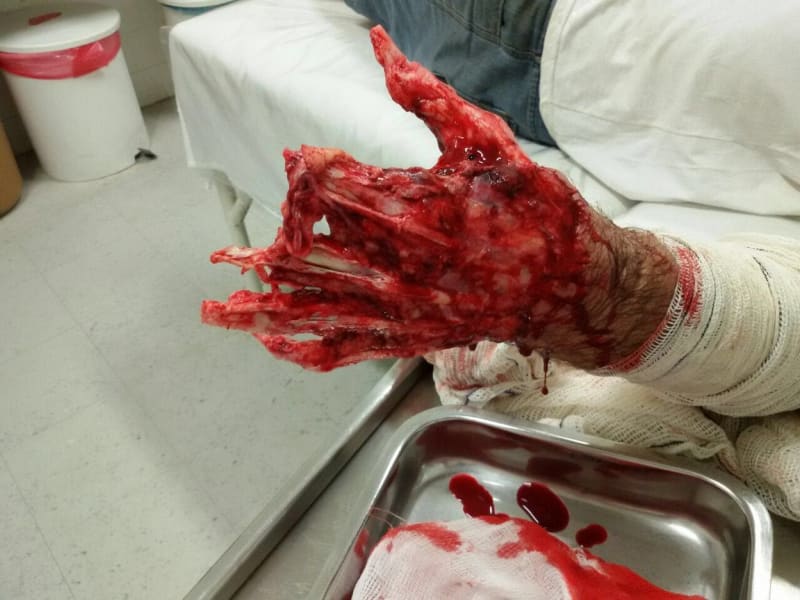 Takhle vypadala jeho znetvořená ruka po nehodě.