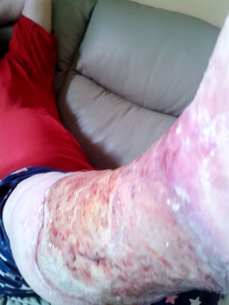 Ženě museli amputovat nohu poté, co se řízla při holení 5