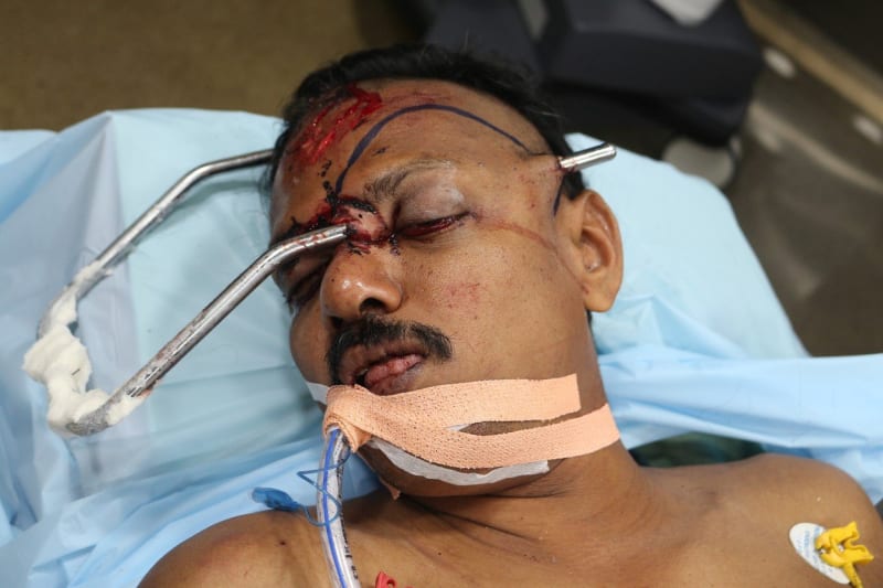 Muž skončil s kovovou tyčí zaraženou v obličeji 4