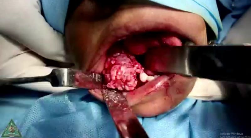 Lékaři vyoperovali chlapci z úst obří množství zubů 6