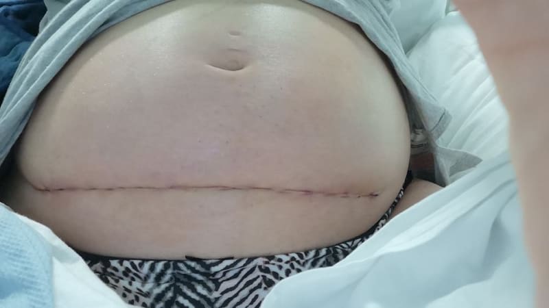 Ženě vyjmuli dítě z dělohy kvůli operaci 6