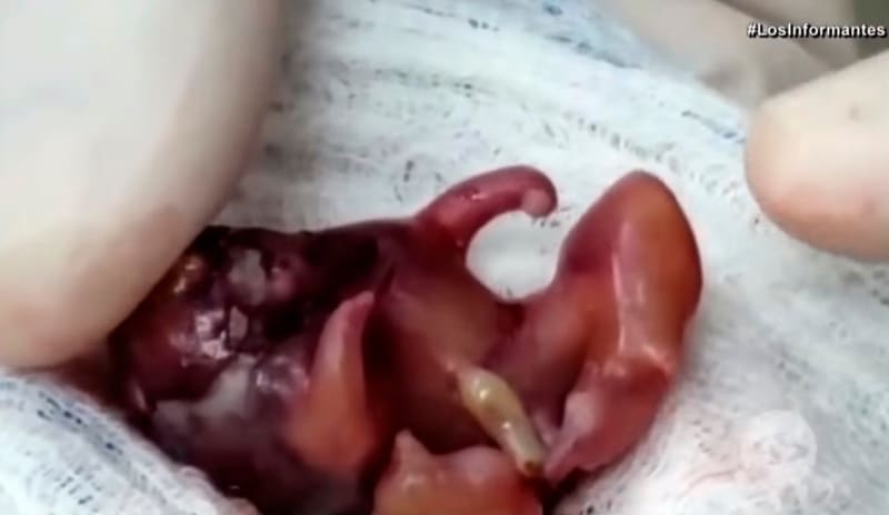 Dítě se narodilo s dvojčetem v žaludku 1