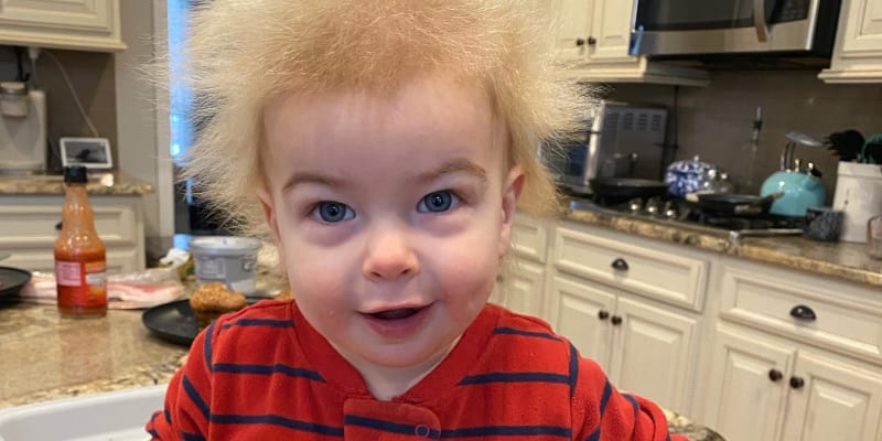 Desetiměsíční Locklan trpí syndromem neučesatelných vlasů.