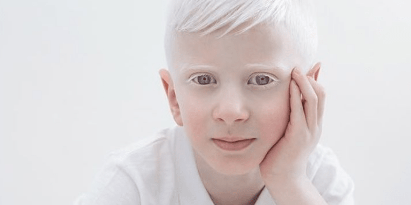 Krása lidí s albinismem 5