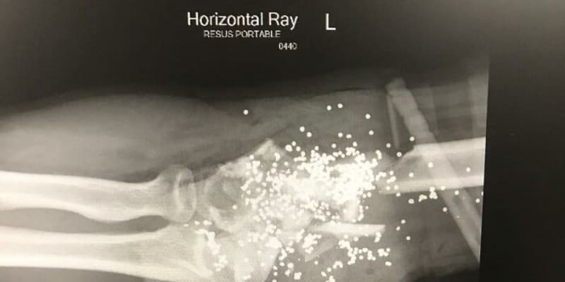 Takhle vypadá rentgen lokte po zásahu kulky z brokovnice.