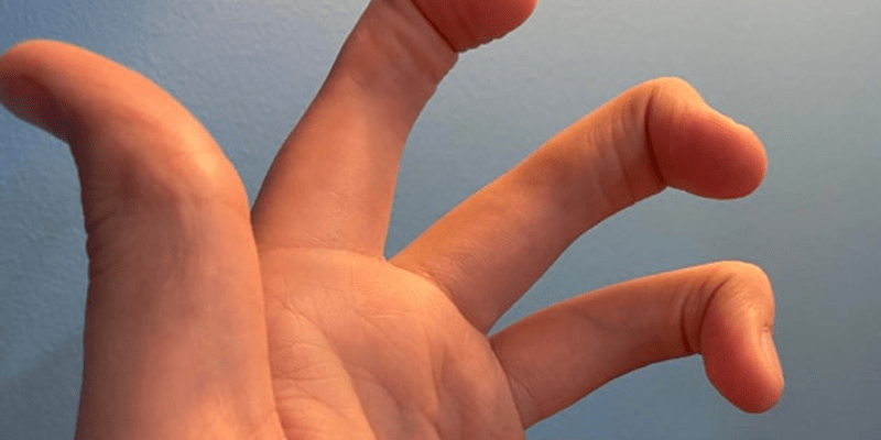 Všech pět prstů postrádá prostřední kloub