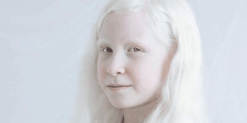 Krása lidí s albinismem 4