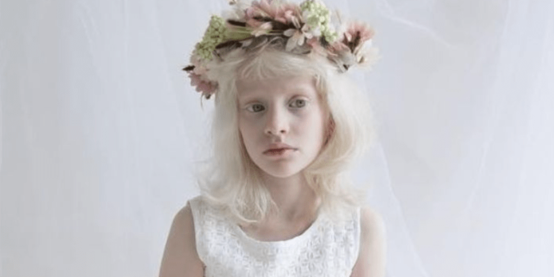 Krása lidí s albinismem 6