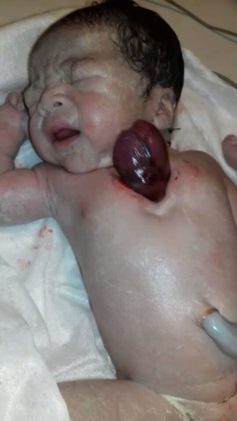 Holčička byla po porodu převezena na operaci.