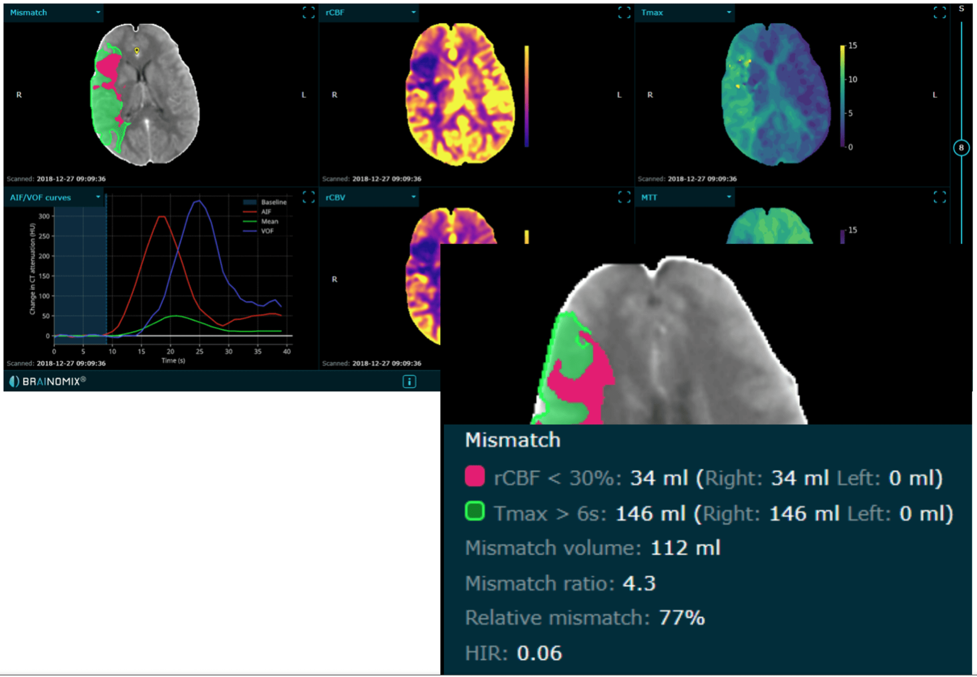Ilustrační snímek CT perfúzního vyšetření (červeně zobrazeno tzv. jádro ischémie a zeleně tkáň, kterou můžeme efektivní léčbou zachránit, tzv. penumbra) – vše hodnoceno automaticky softwarem Brainomix.