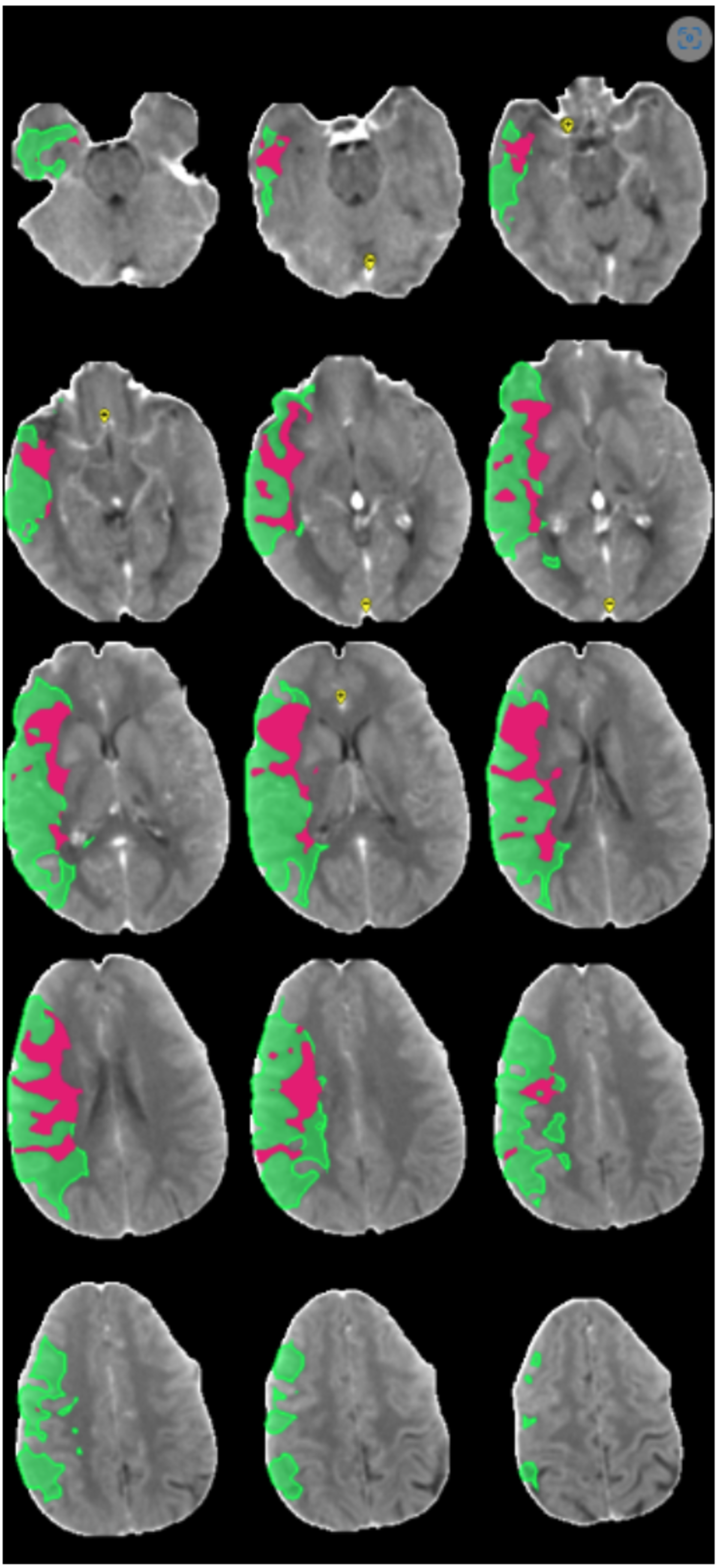 ilustrační snímek CT perfúzního vyšetření (červeně zobrazeno tzv. jádro ischémie a zeleně tkáň, kterou můžeme efektivní léčbou zachránit, tzv. penumbra) – vše hodnoceno automaticky softwarem Brainomix.