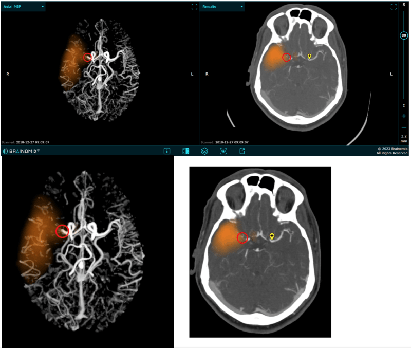 Automaticky lokalizovaný uzávěr mozkové tepny (červené kolečko) ve střední mozkové tepně