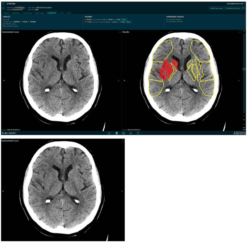 Nativní CT mozku před hodnocením Brainomixem (databáze FNO)
