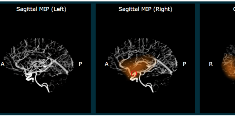Automaticky lokalizovaný uzávěr mozkové tepny (červené kolečko) ve střední mozkové tepně