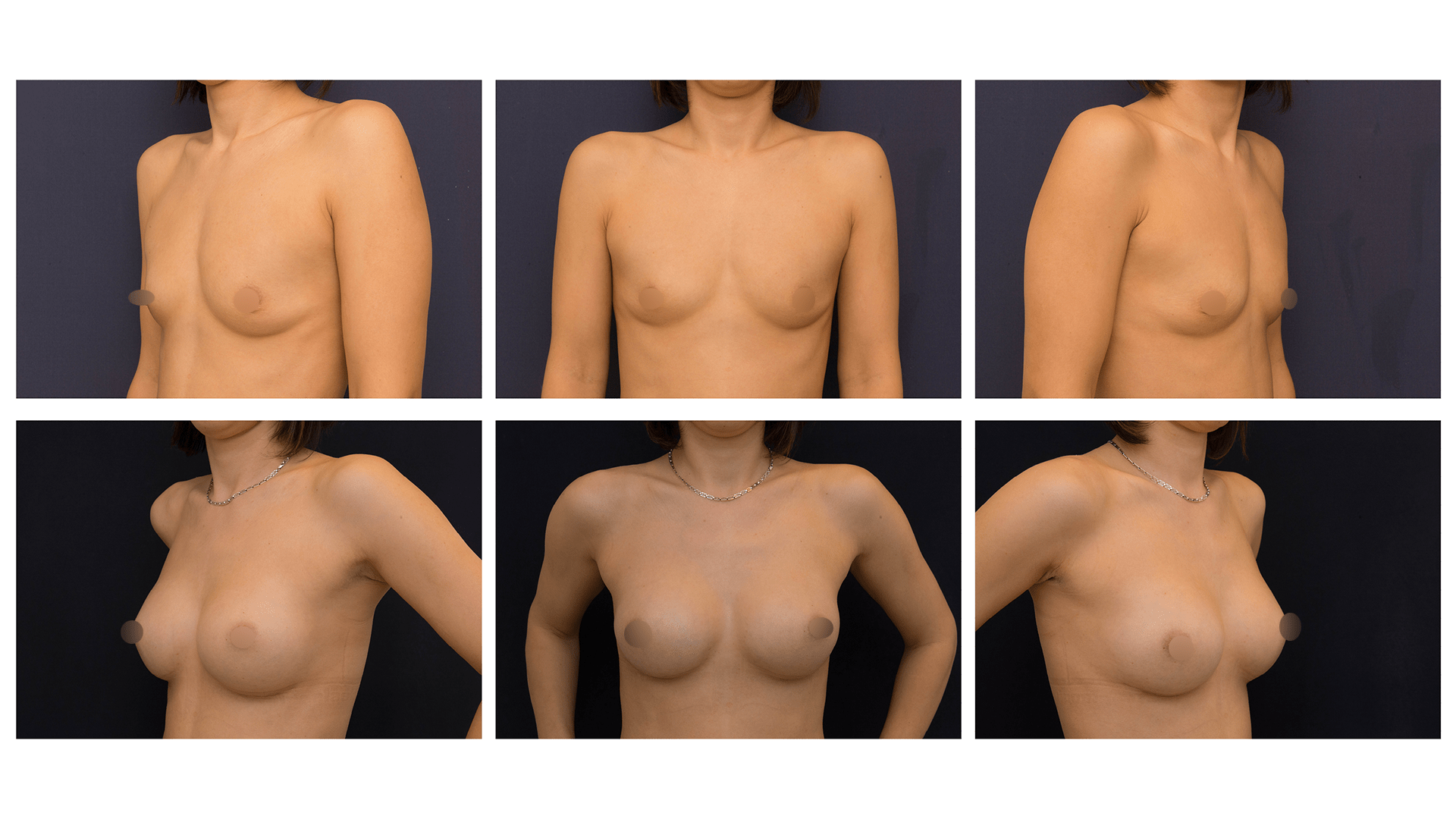 Ukázka augmentace (zvětšení) prsou
