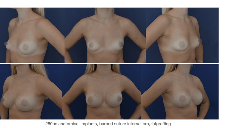 Ukázka pokročilých technik tvarování prsou