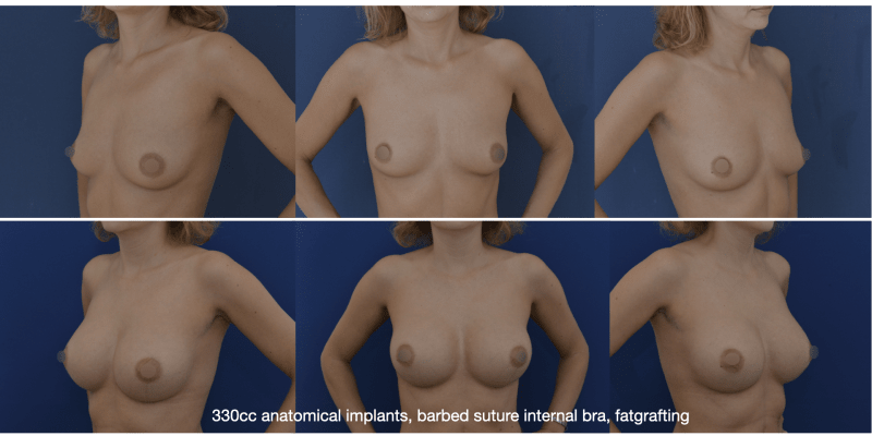 Ukázka pokročilých technik tvarování prsou