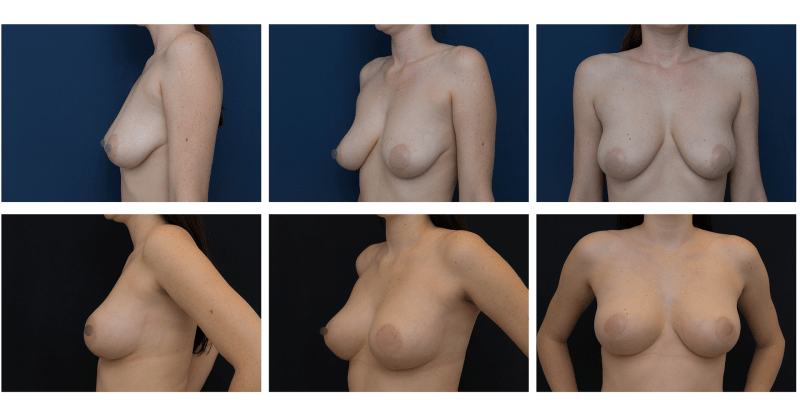 Ukázka modelace prsou