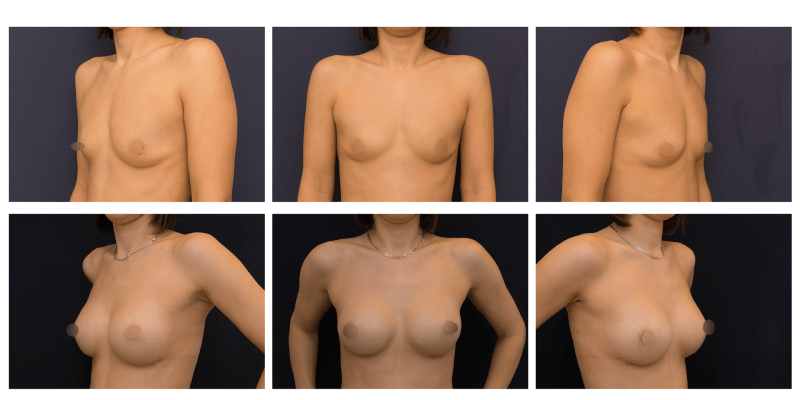 Ukázka augmentace (zvětšení) prsou