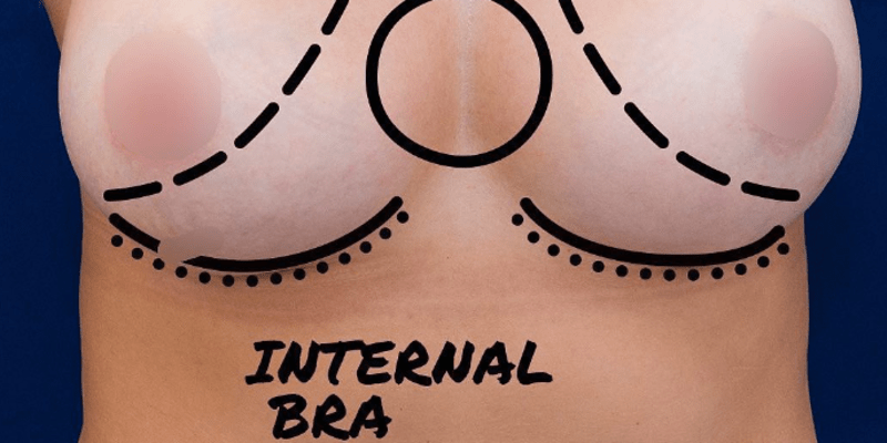 Uvažujete nad úpravou prsou? Moderní techniky nabízejí mnoho možností, jak prsa tvarovat.