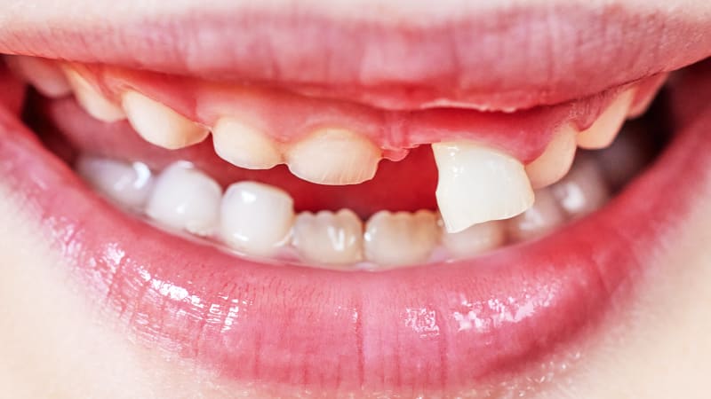 Zubní problémy trápí často děti (ilustrační foto)