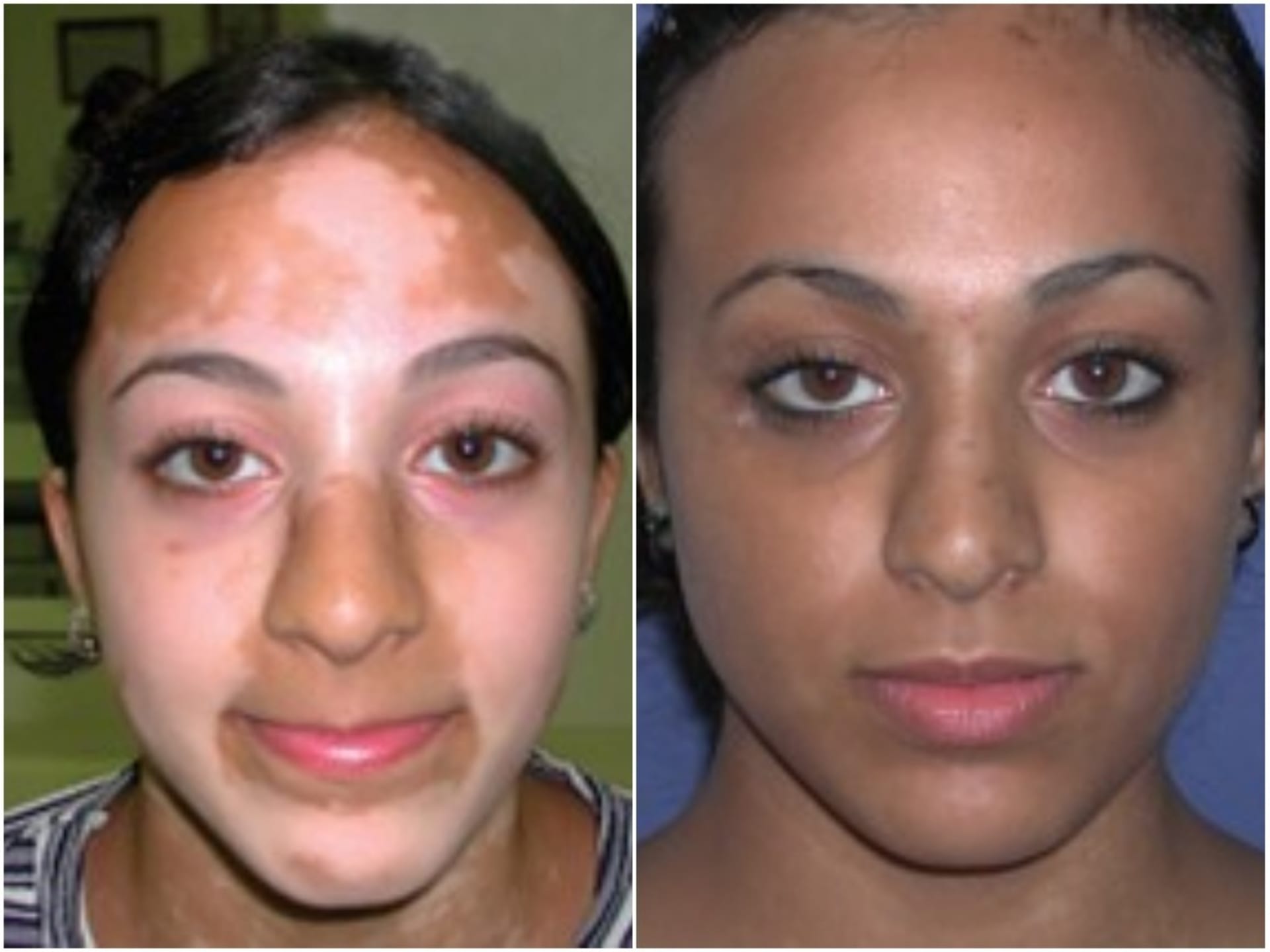 Vitiligo na obličeji - Před léčbou a po ní