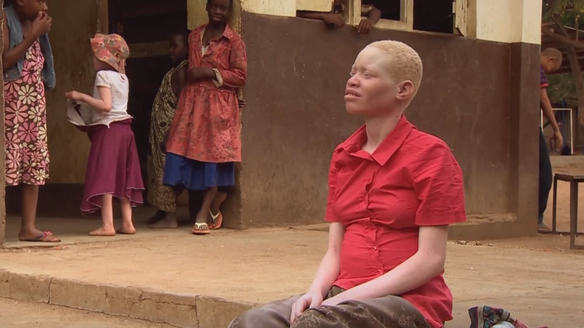 Prokletí afrických albínů