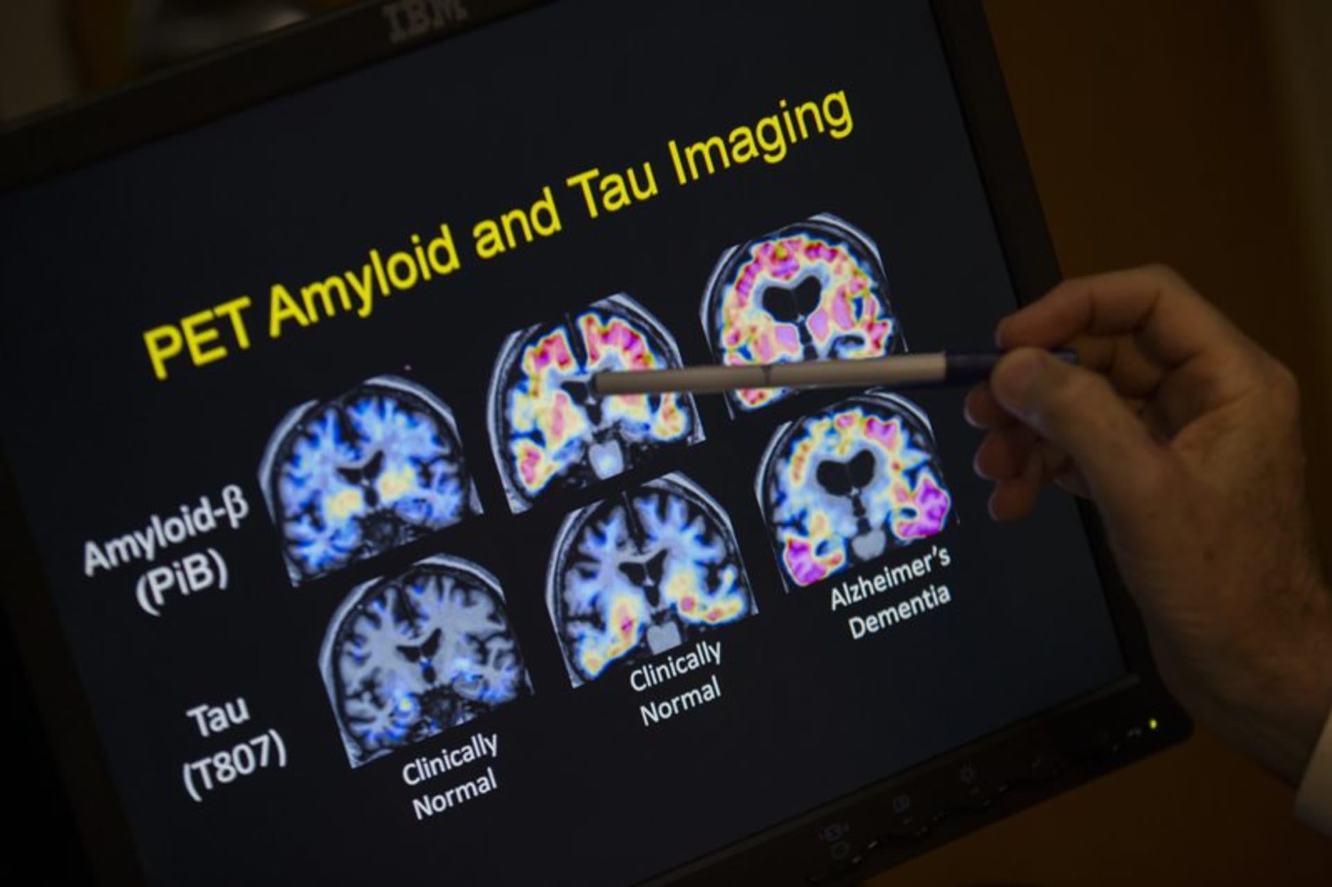 Alzheimerovu nemoc chtějí experti diagnostikovat pomocí skenu mozku