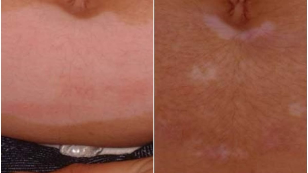 Vitiligo na břiše - Před léčbou a po ní