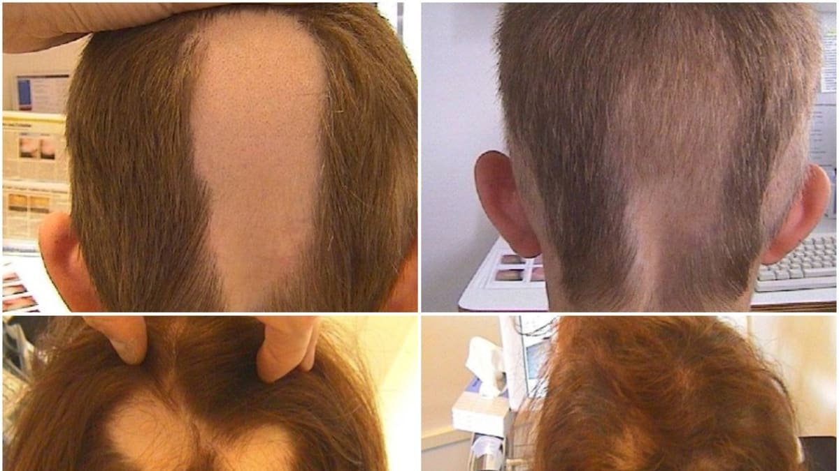 Alopecie - Příklady úspěšné léčby u dvou pacientů