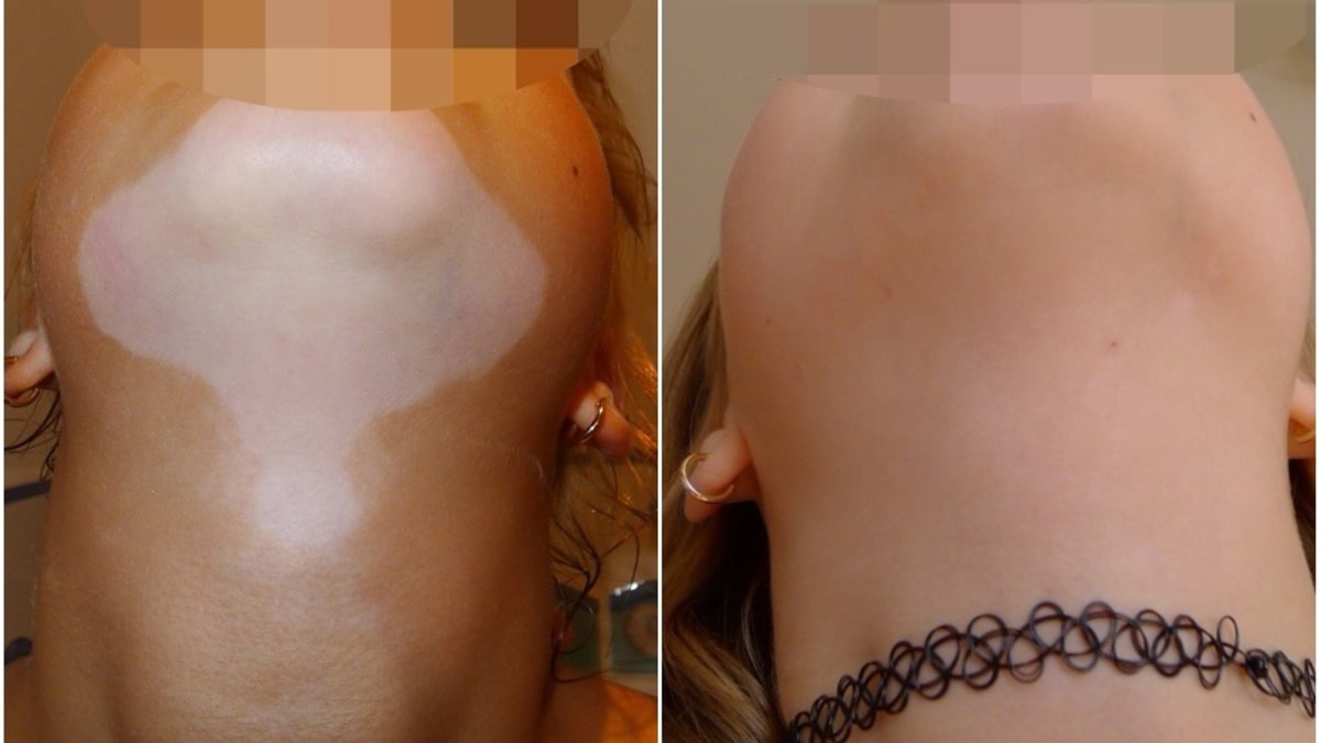 Vitiligo na krku a bradě - Před léčbou a po ní