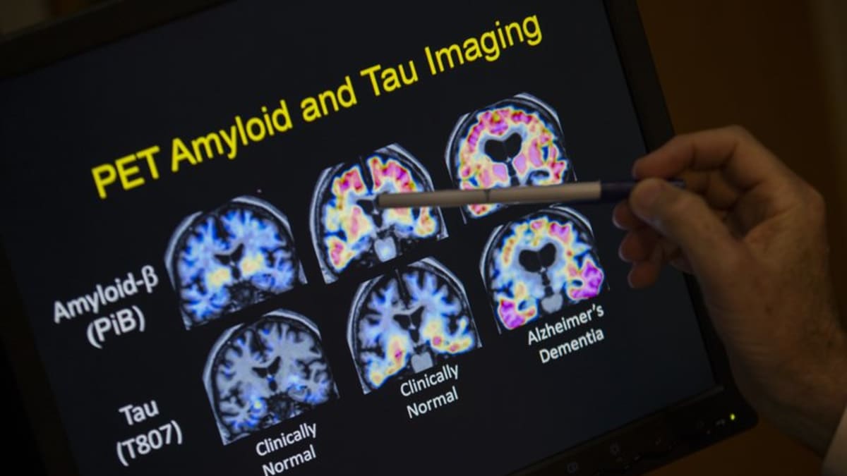 Alzheimerovu nemoc chtějí experti diagnostikovat pomocí skenu mozku