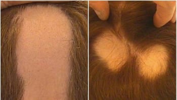 Alopecie: Nemoc vypadávání vlasů. Co ji způsobuje, a lze se jí zbavit?