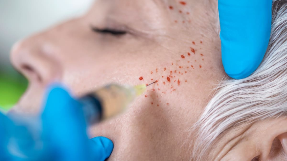 Procedura PRP vstřikování plazmy bohaté na krevní destičky do kůže na obličeji