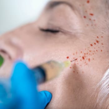 Procedura PRP — vstřikování plazmy bohaté na krevní destičky do kůže na obličeji