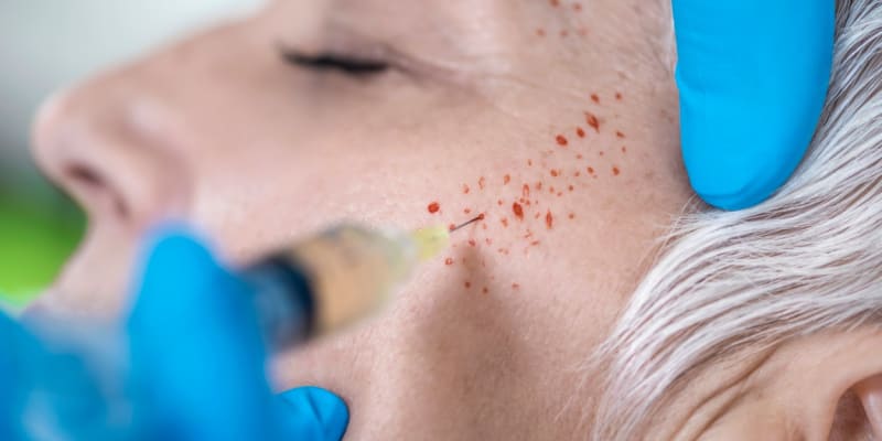 Procedura PRP vstřikování plazmy bohaté na krevní destičky do kůže na obličeji