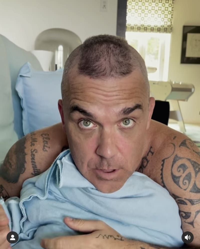 Robbie Williams tvrdí, že má botox i výplně kolem očí