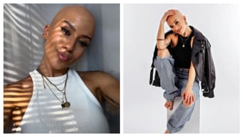 Barbora o životě s alopecií: Pomohlo mi přestat se skrývat. Noste holé hlavy s hrdostí
