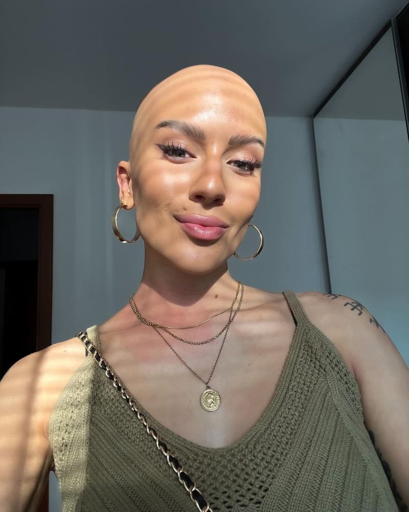 Barbora Kropáčková má alopecii.